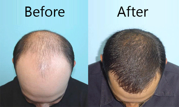 The Future of Hair Transplant Industry - Treatment Cost and Reviews of Best  Hospitals in India | Doctors Beyond Borders